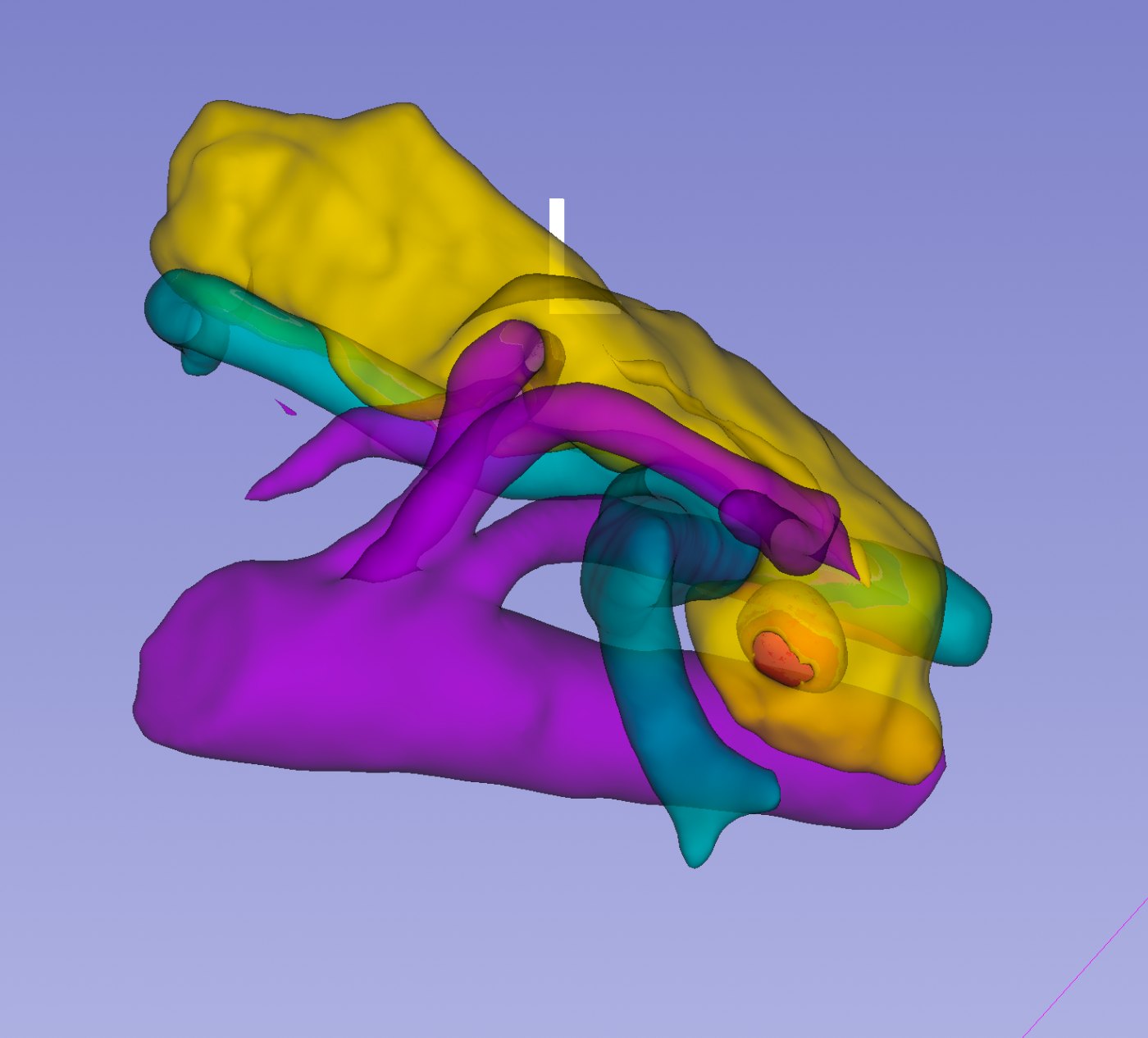 Rendu tridimensionnel de la segmentation : pancréas en jaune, tumeur en rouge, artères en violet, veines en cyan.